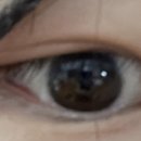 미호성형외과의원 | 쌍수후기 | 쌍꺼풀 재수술 어쩌다보니 자연유착 2회차..(feat.미호성형외과)