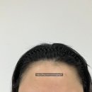 선헤어라인 | 광주수완지구눈썹 잘하는곳 선앤라인 헤어라인SMP 받은 후기