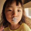 오성치과의원 | (예+76개월) 반대교합 프리올소(유아 교정) 시작