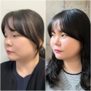 보고또보고 | 홍대피부과 울쎄라프라임+온다 이중턱리프팅 받고온 솔직 후기(효과,통증)