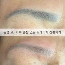 우솔뷰티 | 진주 눈썹 문신제거 푸른 눈썹 제거 푸른 잔흔 제거 우솔뷰티