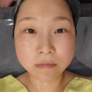 명지베스트성형외과의원 | 부산 올타이트 리프팅 400샷 후기, 통증 적고 전후관리 구성까지 대만족