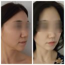 뤼미에르 에스테틱 | 파주피부관리 뤼미에르 에스테틱에서 리프팅 울쎄라 후기