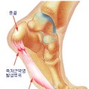 족저근막염 예방법 및 치료 이미지