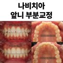 나비치과의원 | 나비치아 앞니 부분교정 5개월 개선 사례. 어금니는 그대로, 치간삭제로 공간 확보