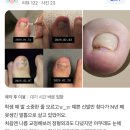판교이엠365의원 네이버블로그