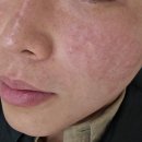 스노우의원시흥배곧점 | 시흥 배곧 피부과 후기｜2년 방치 피부, 피코토닝+물광주사 솔직 후기