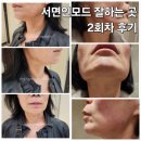 서면인모드 잘하는 피부과 추천, 인모드 2회차 후기
