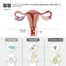 질 및 외음부의 기타 염증[other inflammation of vagina and vulva] 이미지