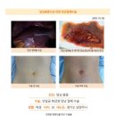 담낭용종수술후기. 김정윤 원장님이 단일공복강경으로 흉터도 적고 실력좋게 하신다고 후기를 많이 봐서 진료를 한번 받아보고 결정하기로... 이미지