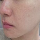샤인멍 | 동탄 반송동피부과 리쥬란hb 효과 통증 가격 후기