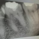 치아 신경치료 크라운(신관동 제일치과) 이미지