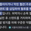 stent 박기 이미지