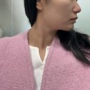 에이스여성의원 | 광화문 피부과 써밋의원 30대 여성 인모드 포마+보톡스 솔직 내돈내산 후기