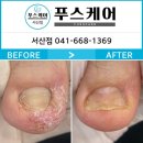 포쉬네일이마트 - 7709 | 서산내성발톱하면 “이마트지하1층”으로 소문난 이유