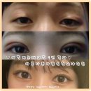 아름다운사람성형외과의원 네이버블로그