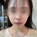 5748 | 강남역피부과 강남피부과추천 티타늄30kj 리프팅효과 후기｜얼굴탄력리프팅 제대로 느낀 날