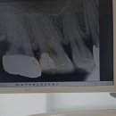 산성예스치과의원 네이버블로그