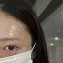 이의원 | 서울 마포 공덕 이멀스의원 편평사마귀 제거 후기