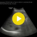 double channel sign(intrahepatic duct and portal vein are note) 이미지