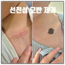 아이사랑병원 | 선천성 모반 제거 수술 후기 아이 실비 (명지 베스트성형외과)