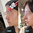 오블리성형외과의원 | 매부리코수술 후기, 단순 다듬기만 하면 안되는 이유와 무보형물 코수술 방법