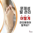 나도손톱 레푸스 개봉점 네이버블로그