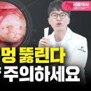 이 닦을 때 이 치약을 사용했더니 치석이 사라지기는커녕 치아가 망가졌습니다(불소, 요오드, 치아불소증, 골격불소증, 갑상선, 골육종) 이미지