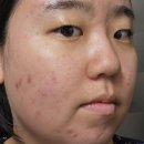 물오름 | 더물오름 에스테틱 여드름 관리 후기｜트러블, 붉은피부, 흉터 관리에는 더물오름 약초필!