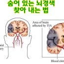 뇌경색을 미리 알기 이미지