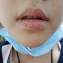 미시간피부과의원 | 박탈성구순염치료기 #4 결국 한림대 피부과를 찾아가다