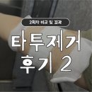 신보건약국 | 신촌 연세스타피부과 타투 제거 2회차 후기(전후 비교, 여름 관리, 통증)