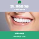 강남심미치과보철과치과의원 | 강남역치과 앞니크라운 자연스러운 미소를 위한 심미 보철 치료