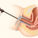 27200-나-22 | 8_자궁내시경 후기 및 비용