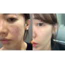 (주)아성다이소 성남모란역점 | 모란역피부과 스킨부스터 올리디아 효과 추천 콜라겐주사