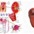 의학상식 - 신장염의 원인과 증상 치료법 이미지