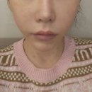 피엠씨 - 창원시 진해구 석동로73번길 23-5 | [선정릉/선릉역 주변 피부과] PMC (재생+잔주름) 시그니처 스킨부스터 후기✨💉🌿🫧
