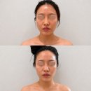 이플 에스테틱 - 달성군 | 광주북구피부관리 이플에스테틱 하이퍼소닉 윤곽 상체 효과가 뚜렷한 확실한 관리 후기