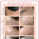 콜드플라즈마 이미지