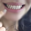 파란치과의원 | 첫 치아미백 도전 '청담클린치과의원'과정 &amp; 비포애프터