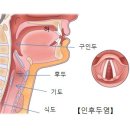 인후두염(Laryngopharyngitis) 목감기 이미지