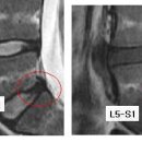 비타파워님의 요추디스크 L5-S1 MRI 판독입니다. 이미지