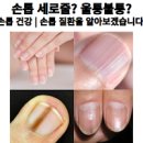 손톱 울퉁불퉁 세로줄 걱정된다면 이미지