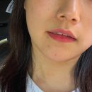 민간약초 생활한방 | 대구 여드름 치료한의원 | 여드름압출 마무리+ 약초침 후기(내돈내산)