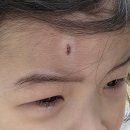 수병원 | 아이 이마 흉터 레이저 치료 후기 한강수병원 아이흉터전문병원 비용 관리까지 적은 후기