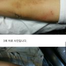 대상포진 이미지