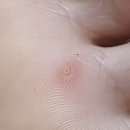 안일약국 | 티눈인줄알았지만 사마귀 티눈밴드로 사마귀제거 실패후기 사마귀초기