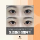 6389 | 압구정역 피부과 눈매와 인상까지 바꾸는 디테일 애교필러 후기