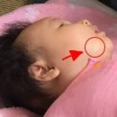 신생아 피부트러블 혹시 백반증? 아기 백반증 흰 반점 원인과 치료 대처법 이미지