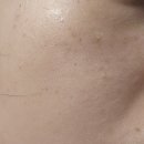 압구정로 | 압구정 루나의원 루비레이저 후기!! (받은 당일 ~ 시술 한달 후+가격+자그만 팁)